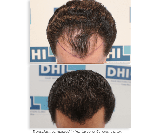 Natural results after DHI Hair Transplant